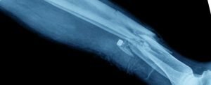 Broken Fibula.