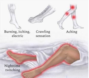 Medical illustration showing common symptoms of restless legs syndrome (RLS), including burning, itching, crawling sensations, aching legs, and nighttime twitching that can disrupt sleep.