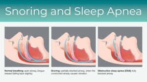 Medical illustration comparing normal breathing, snoring, and obstructive sleep apnea, showing how the airway changes from open to partially and fully blocked during sleep.